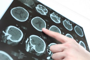 A Traumatic Brain Injury Today Could Lead to Parkinson’s in the Future A Traumatic Brain Injury Today Could Lead to Parkinson’s in the Future