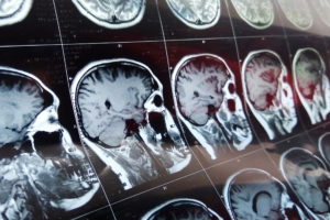 Everything You Need to Know About Recovering Damages After a Traumatic Brain Injury in California